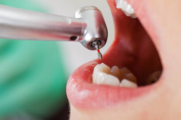 Best Emergency Root Canal Treatment in Port Lavaca, TX